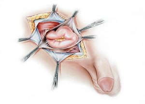 ernia-inguinale-spaccato-corpo-umano