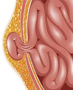 fuoriuscita-ernia-inguinale