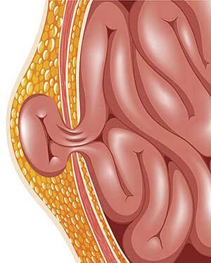 fuoriuscita-ernia-inguinale