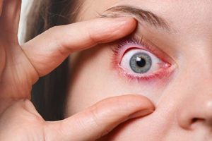 reazione allergica al makeup degli occhi? Ecco i sintomi