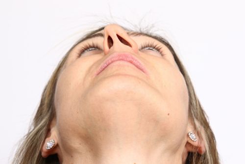 deviazione del setto nasale